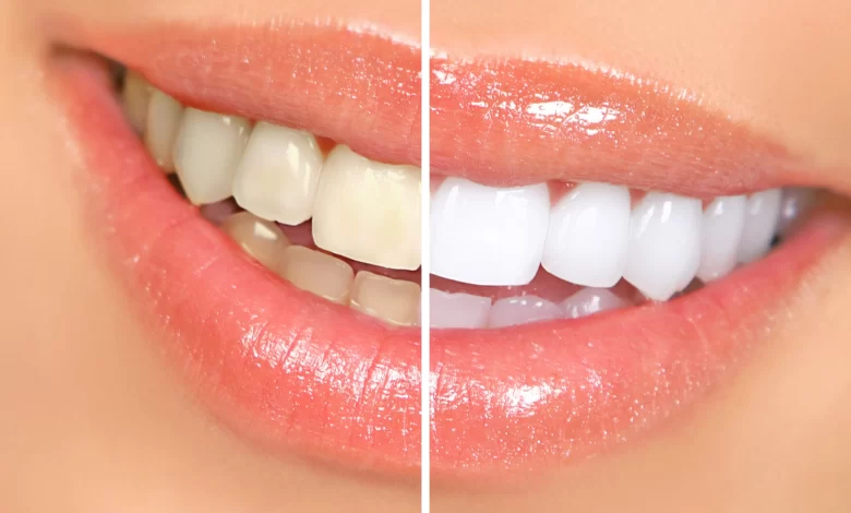 How To Quickly And Easily Get A Brighter Smile: All About Teeth Whitening Services